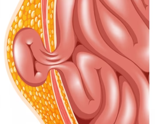 Demystifying Hernias: A Comprehensive Guide